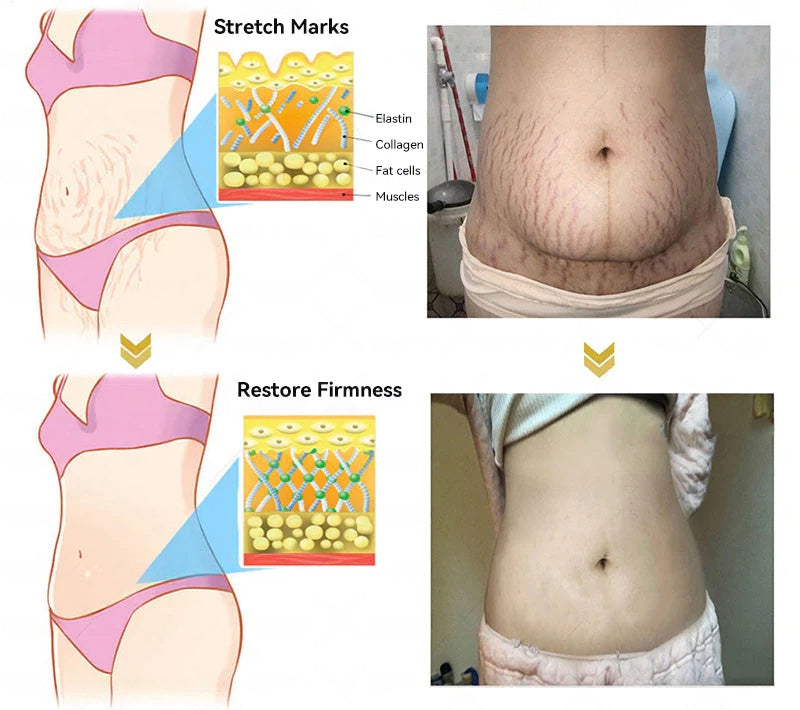 Botox Bee Venom Skin Restoration Cream - Anti-aging, Hydrating, Skin Firming & Lifting, Skin Repair, Even Tone, Acne and Dark Spot Treatment, Wart and Mole Removal, and Psoriasis Relief.