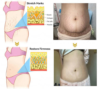 Botox Bee Venom Skin Restoration Cream - Anti-aging, Hydrating, Skin Firming & Lifting, Skin Repair, Even Tone, Acne and Dark Spot Treatment, Wart and Mole Removal, and Psoriasis Relief.