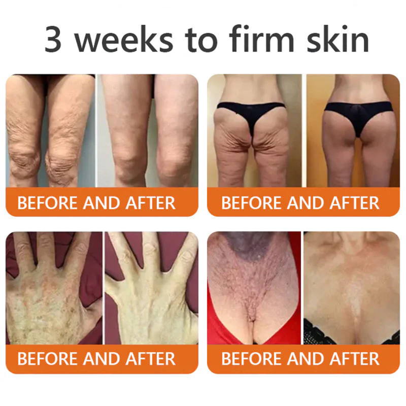 Botox Bee Venom Skin Restoration Cream - Anti-aging, Hydrating, Skin Firming & Lifting, Skin Repair, Even Tone, Acne and Dark Spot Treatment, Wart and Mole Removal, and Psoriasis Relief.